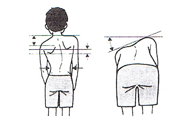 ①背骨の曲がり具合はどうか